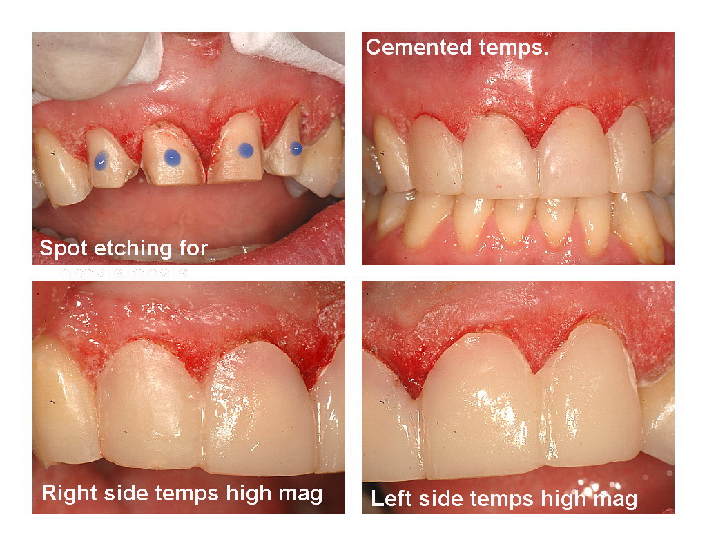 Veneers and recontouring pg7.jpg